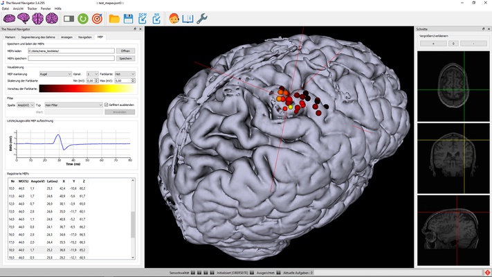 In kaart brengen van de motorcortex bij herseninfarcten