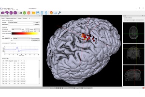 TMS motor mapping in stroke