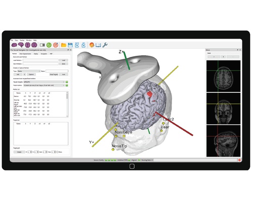 Added value of MRI-guided neuronavigation