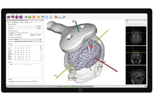 Added value of MRI-guided neuronavigation