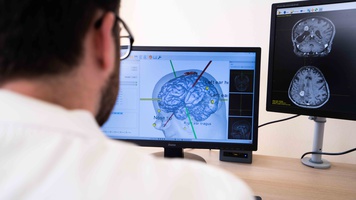 Planning glioma resection with MRI-guided neuronavigated Transcranial Magnetic Stimulation