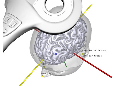 Neuronavigation for TMS